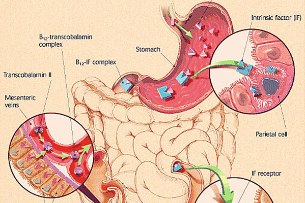 Gastric Cancer and Pernicious Anaemia